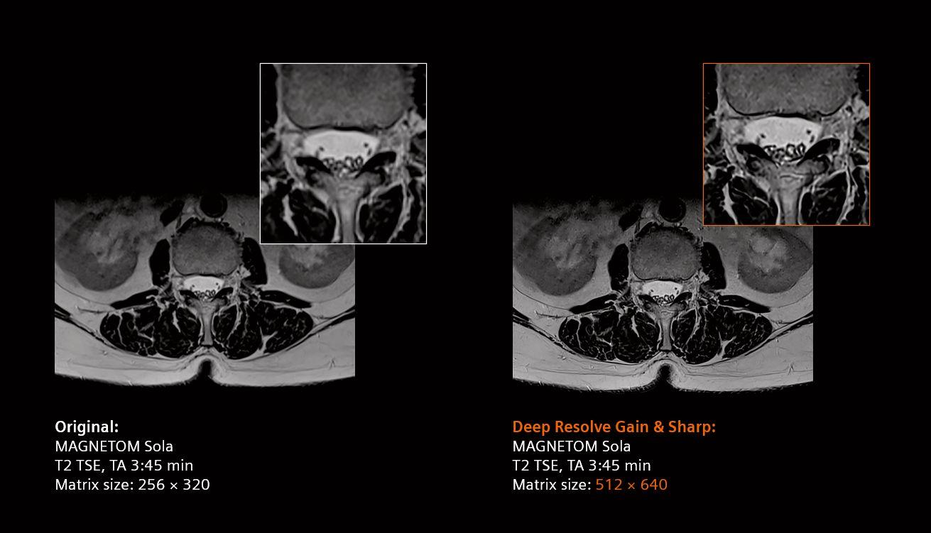 MRI – Wirbelsäule mit Deep Resolve